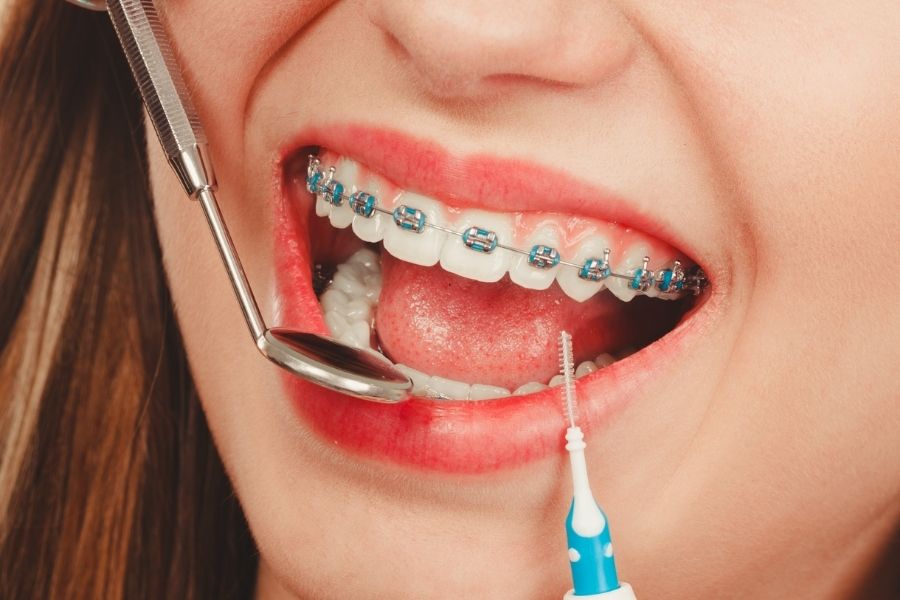 Clear Aligners vs. Ceramic Braces