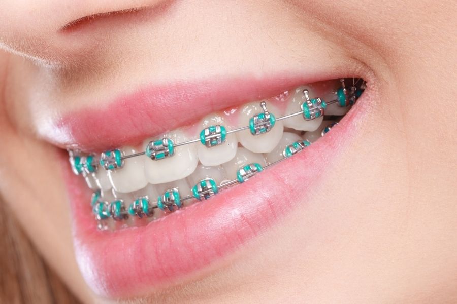 Adult Braces