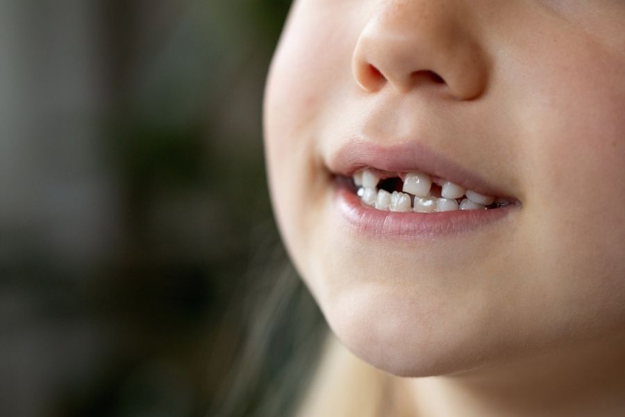 Child Need Phase 1 Orthodontic Treatment