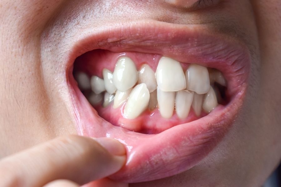 How Long Do Braces Take for Crowded Teeth