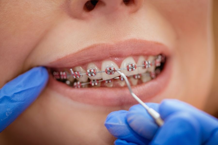 How Long Do Braces Take for Crowded Teeth