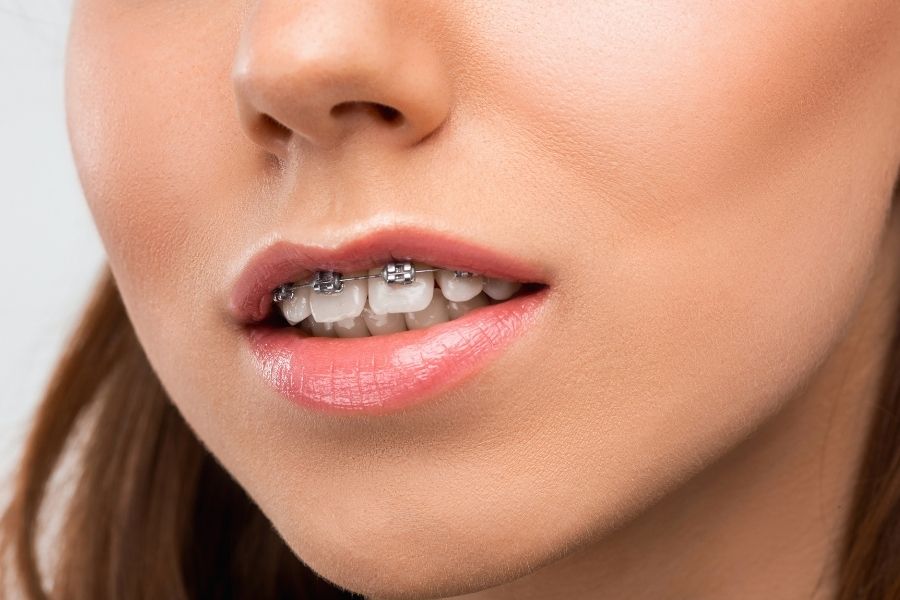 Causes of Open Bite and Correction