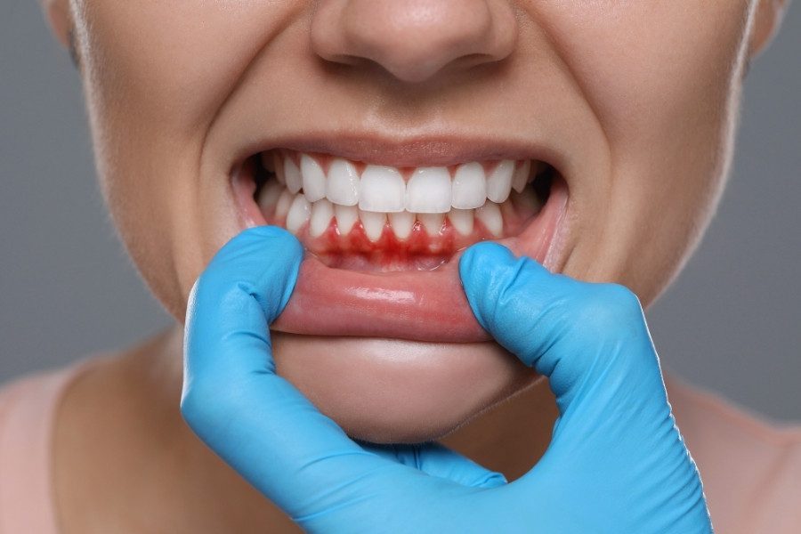 gum disease with braces
