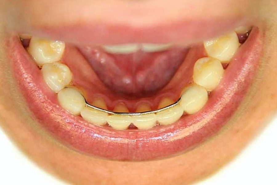 types of retainers after braces​