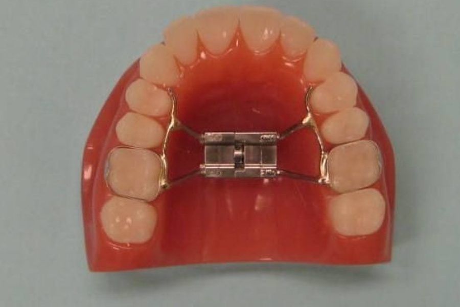how much does a palate expander cost